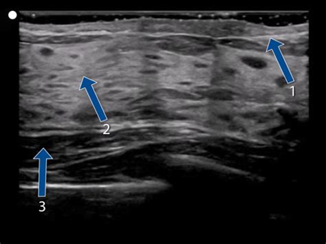 Breast Sonosim Flashcards Quizlet