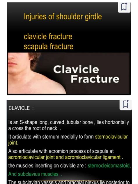 Clavicle Fracture | PDF