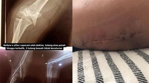 Foto Sadis Bocah Sd Di Sukabumi Luka Parah Akibat Bullying Pengakuan