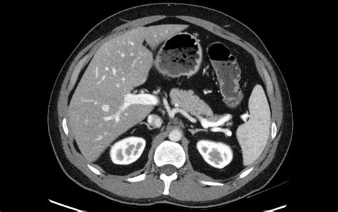 Abdominal CT Genitourinary System LITFL Radiology