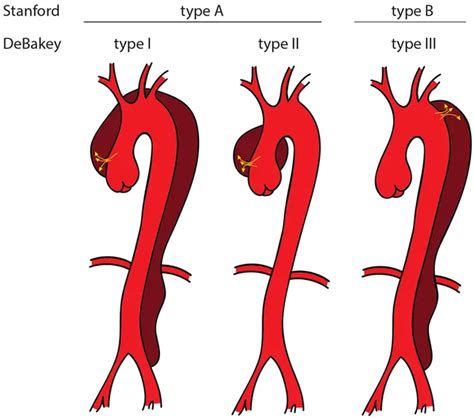 Aortic Dissection Symptoms