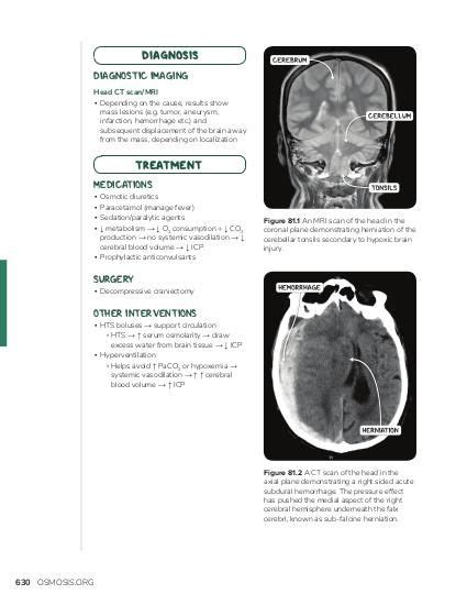 Brain herniation: Video, Causes, & Meaning | Osmosis