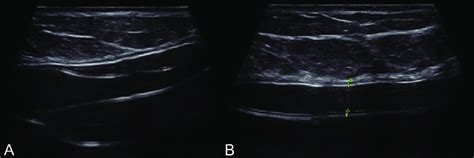 A And B Transverse Ultrasound Image Of A Woman With Intracapsular