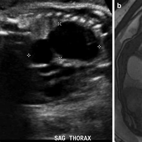 A Prenatal Ultrasound Demonstrates A Bilobed Anachoic 5 2 Â 2 5 Cm