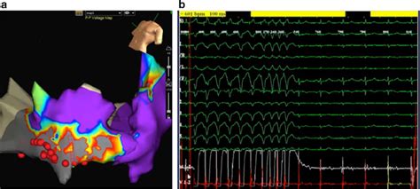 A Electroanatomical Map From Case After Ablation Sites Where Rf