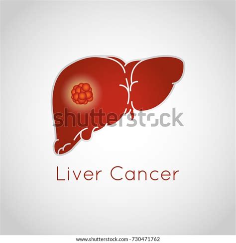 Liver Cancer Vector Logo Icon Illustration 库存矢量图（免版税）730471762 Shutterstock