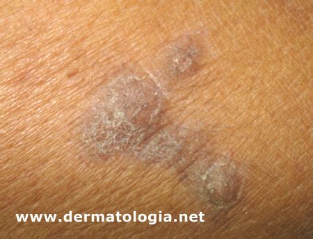 Líquen simples crônico neurodermatite circunscrita Dermatologia