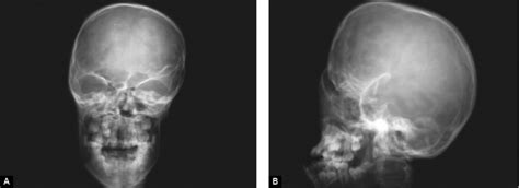 (A) Anteroposterior view of skull and (B) lateral view of skull | Download Scientific Diagram