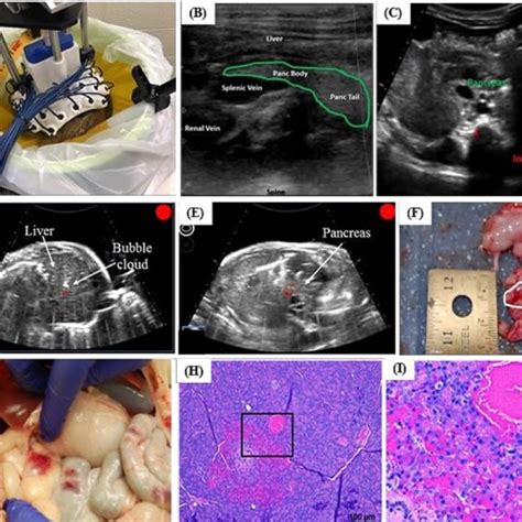 Histotripsy Tumor Ablation In Murine Models A Subcutaneous Murine