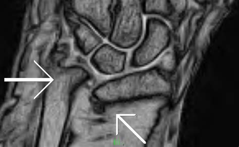 Distal Radioulnar Joint Subluxation Sumers Radiology Blog