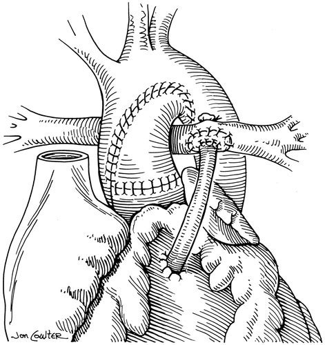 Right Ventricle To Pulmonary Artery Conduit Improves Outcome After