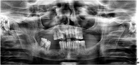 C OPG Shows Decreased Bone Density Multiple Periapical