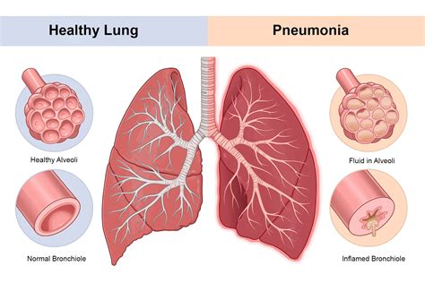 pneumonia cases rise  uk  experts outline   risks