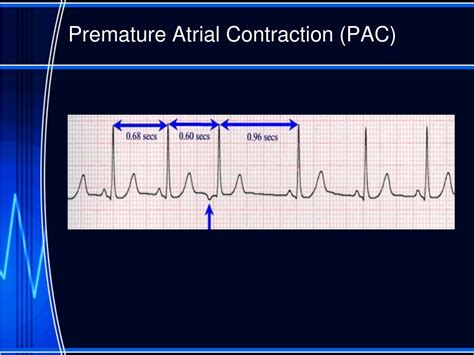 Ppt Nursing Interpretation Of The Electrocardiogram Ecg Telemetry