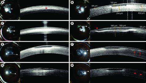 Slit Lamp Photographs And The Corresponding Sd Oct Scans With Corneal