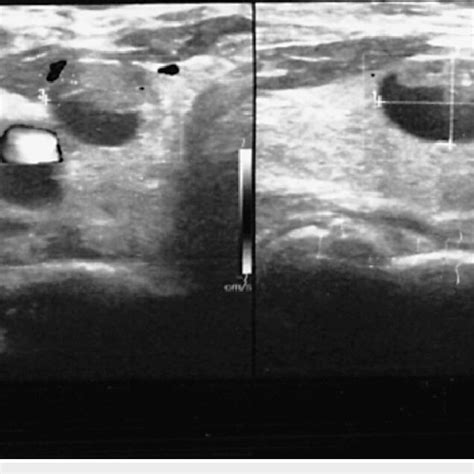 Neck Ultrasound Showing The Thyroid Nodule With Cystic Features And