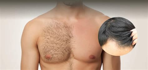 Everything About Bht Hair Transplant Technique Healing Clinic Turkey