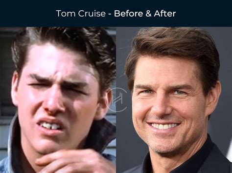 Tom Cruise Teeth Before After