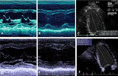 Echocardiography was showed that increased dimension and volume of LV ...