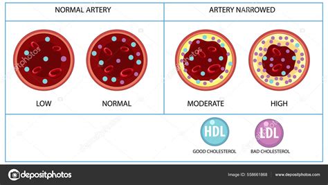 Tipos Ilustra O Colesterol Hdl Ldl Imagem Vetorial De Blueringmedia