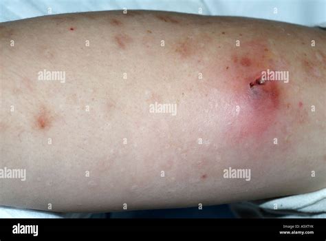 Staphylococcus Aureus Rash