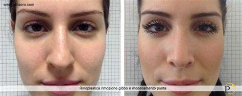 Rinoplastica Foto Pallaoro Medical Laser