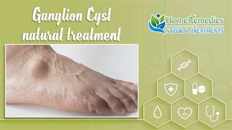 Natural Treatments And Home Remedies For Ganglion Cyst Youtube