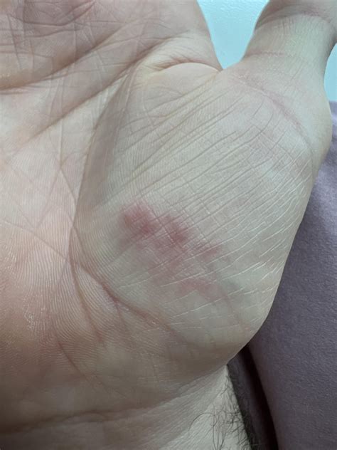 I Have Some Red Raised Bumps On My Palm They Are Dry And Not Itchy But Somewhat Painful Any