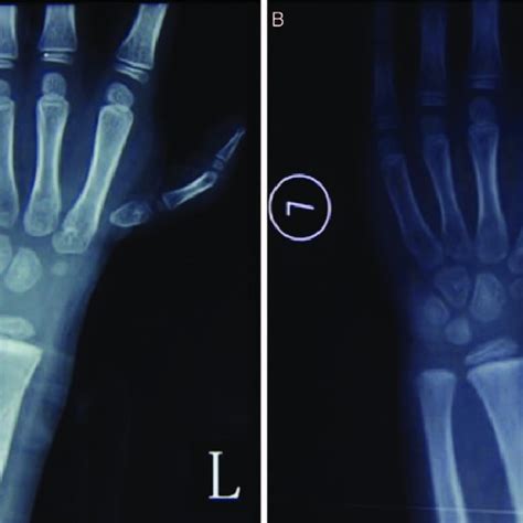 Pre Operative A And 1 Year Post Operative B X Ray Of A Manske Type Download Scientific