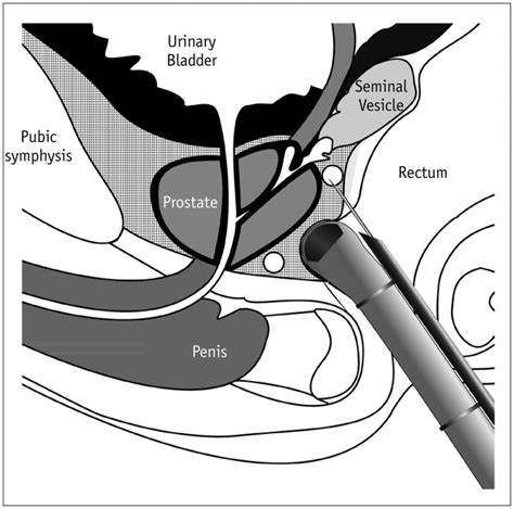 Optimal Position Of Ultrasound Transrectal Transducer With Biopsy Guide Download Scientific