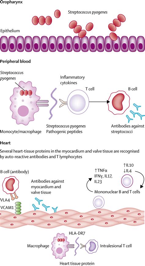 Acute Rheumatic Fever The Lancet