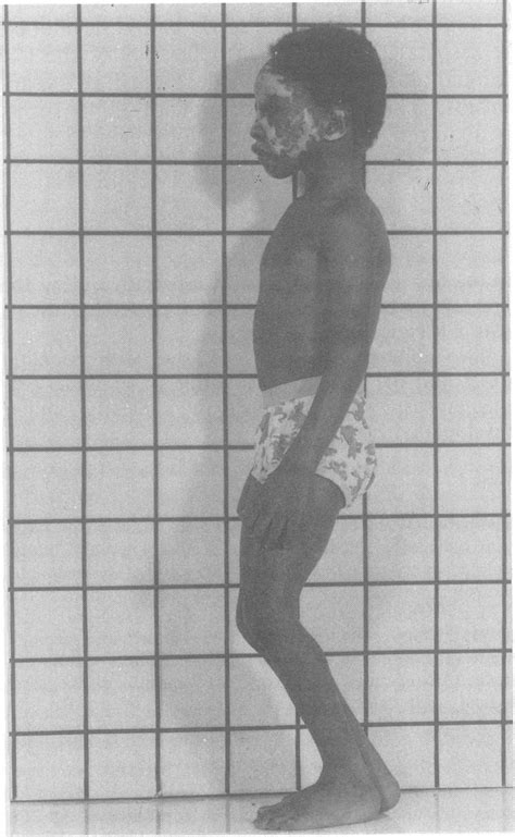 fig abnormal posture  case  withflexion contractures  hips knees