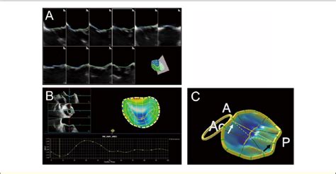 Example Of The Modeling And Quantification Of The Mitral Valve