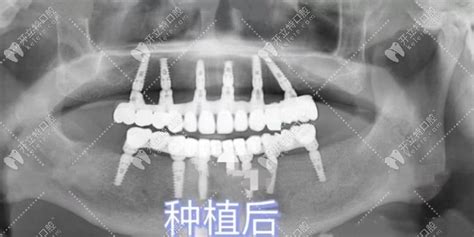 全口无牙种植牙方案的选择allon4allon6半固定种植牙均可选 前沿技术 开立特口腔