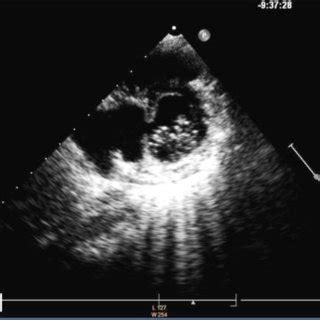 Parasternal short axis view at mitral valve level demonstrating a large ...