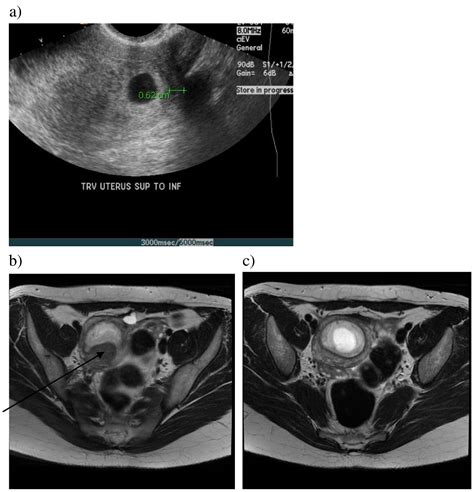 Cornual Interstitial And Angular Pregnancies Clarifying The Terms