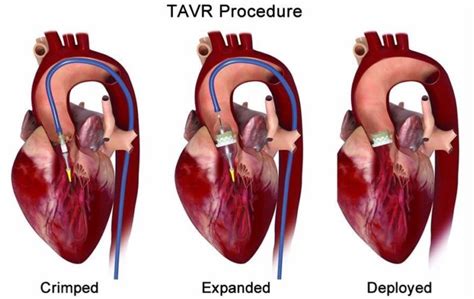 Introduction Du RVAC Et Ses Applications Cliniques Connaissances