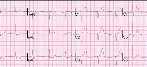 Dr Smith S Ecg Blog Anterior Hyperacute T Waves Look At This Upside