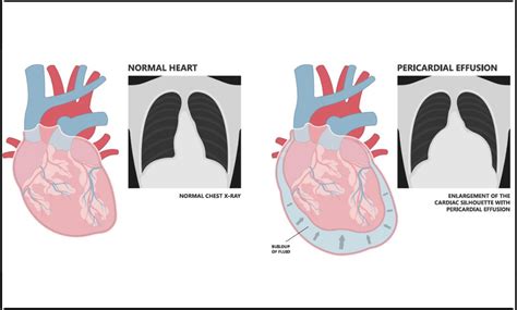 Pericardial Effusion Causes Risk Factors Symptoms Treatment