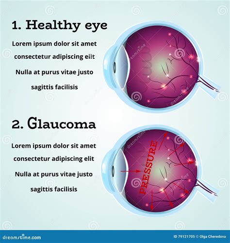 Glaucoma The Eye Disease Vector Illustration 116110936