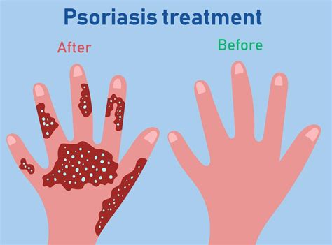 Stages of psoriasis formation. Treatment of psoriasis before and after ...