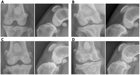 Ad Severity Of Osteophytosis Was Graded As 0 Normal A 1 Mild