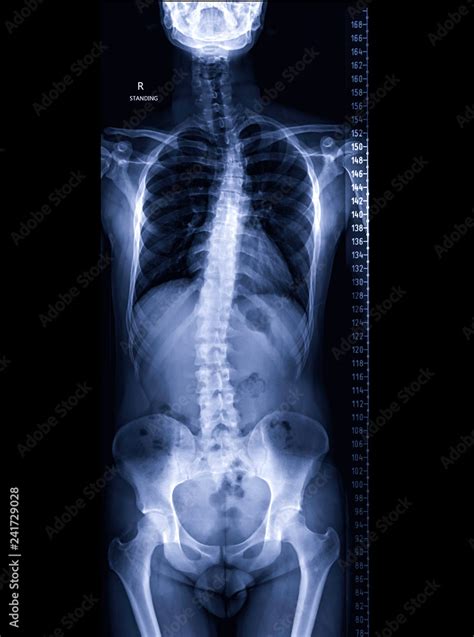 X-ray image of Whole human Spine front view showing scoliosis of thoracic spine. Stock Photo ...