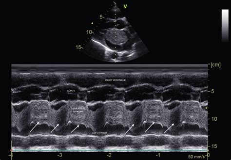 A Large Left Atrium Myxoma Presenting As Positional Pre Syncope