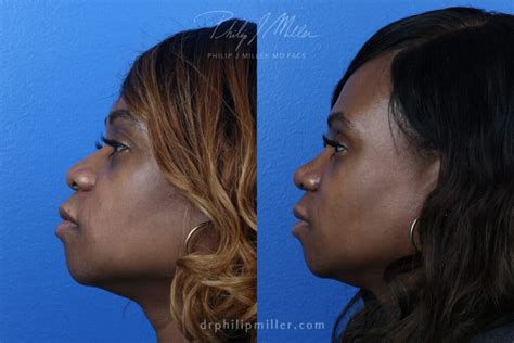 African American Rhinoplasty New York City New York Dr Philip Miller