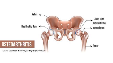 Why Does My Hip Hurt Causes Of Hip Pain Entirely Health