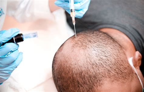 Platelet Rich Plasma Prp Treatment For Hair Loss Myupchar Ayurveda