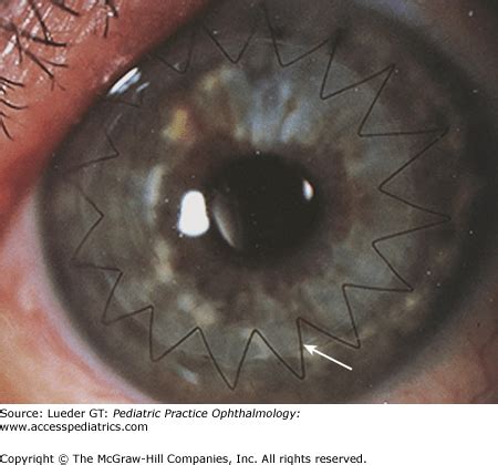 Diseases of the Cornea | Ento Key