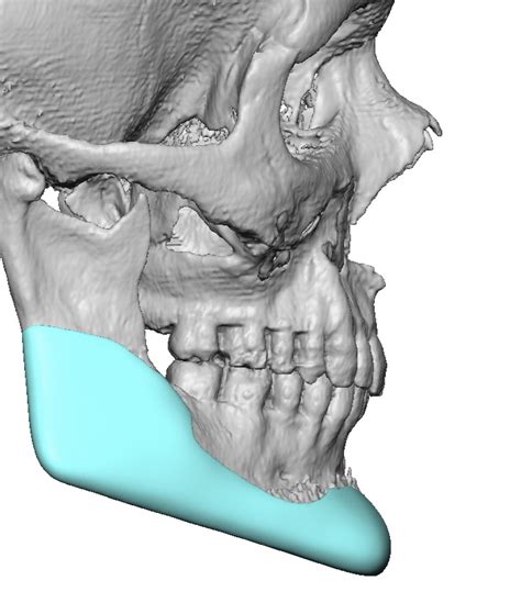 Plastic Surgery Case Study Custom Jawline Implant For D Vertical