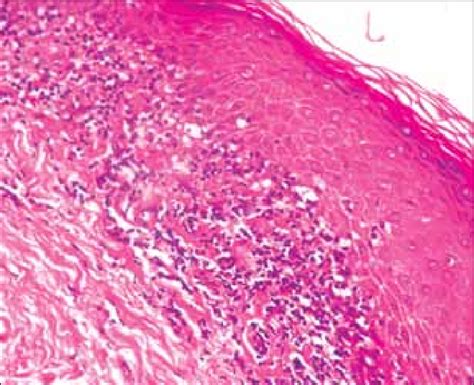 Acanthosis With Hyperorthokeratosis And Hypergranulosis Associated With